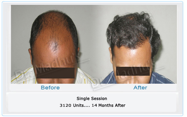 Affordable hair transplant Hyderabad