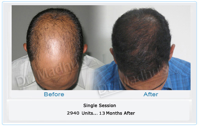 Best FUE hair transplant doctor Hyderabad