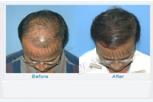 Best hair transplant clinic in Jubilee Hills