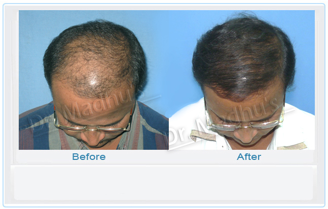 Best hair transplant clinic in Jubilee Hills