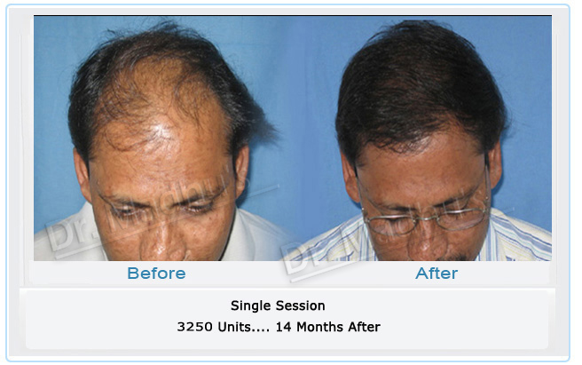 Experienced hair transplant doctor Hyderabad