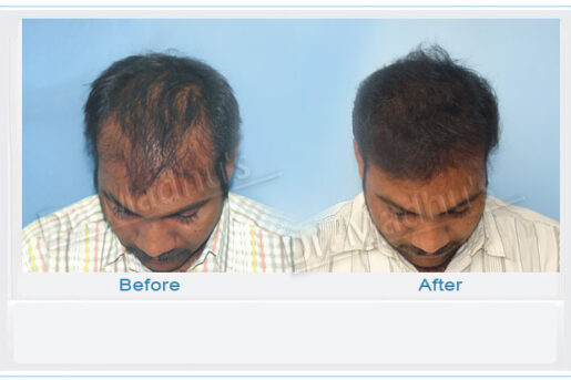 FUE hair transplant Jubilee Hills