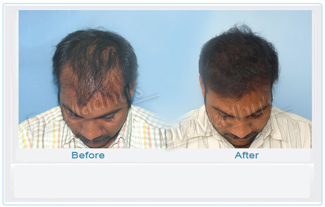 FUE hair transplant Jubilee Hills