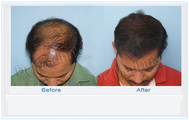 FUE hair transplant results Hyderabad