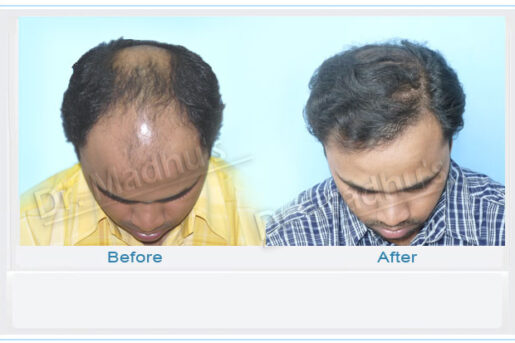 FUT hair transplant Jubilee Hills