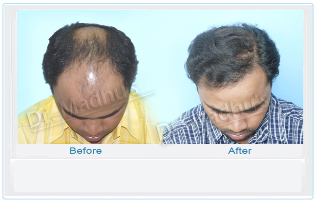 FUT hair transplant Jubilee Hills