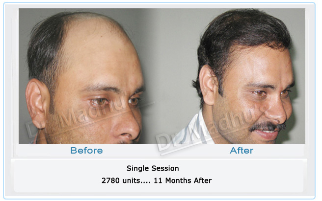 FUT hair transplant cost Hyderabad