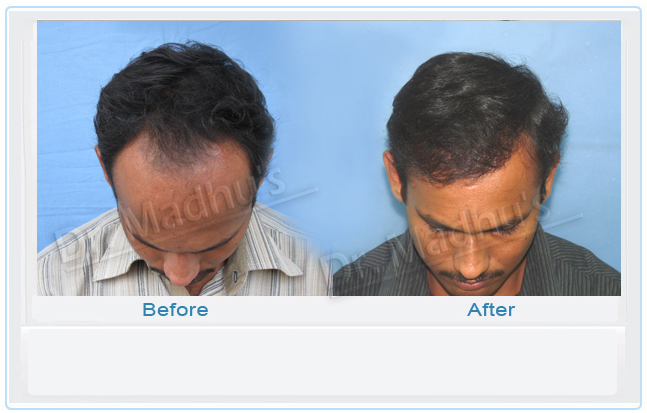 FUT hair transplant results Hyderabad