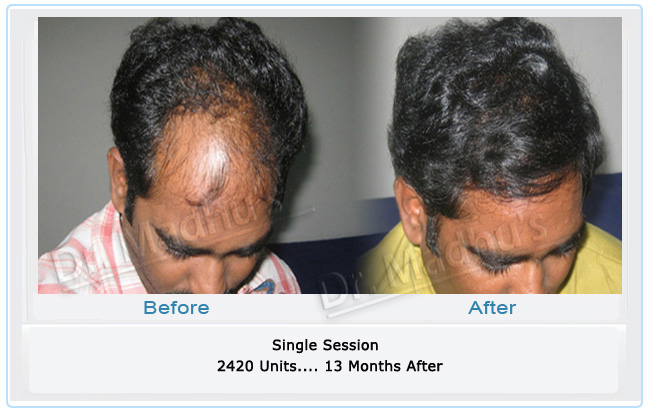 Facial hair transplant Hyderabad