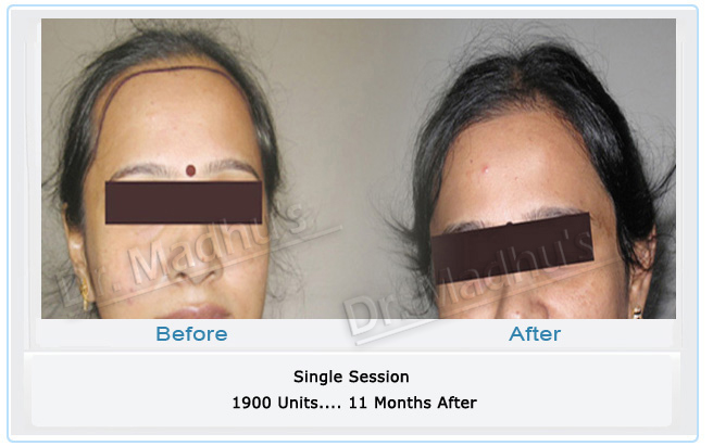 Female hair transplant Hyderabad