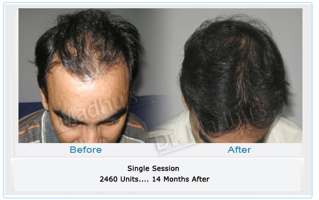 Hair loss treatment for men Hyderabad