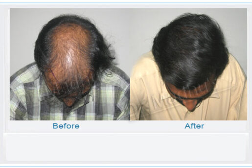 Hair restoration clinic Jubilee Hills