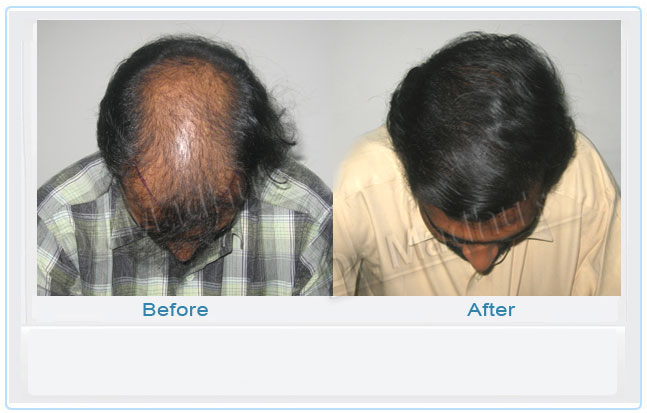 Hair restoration clinic Jubilee Hills
