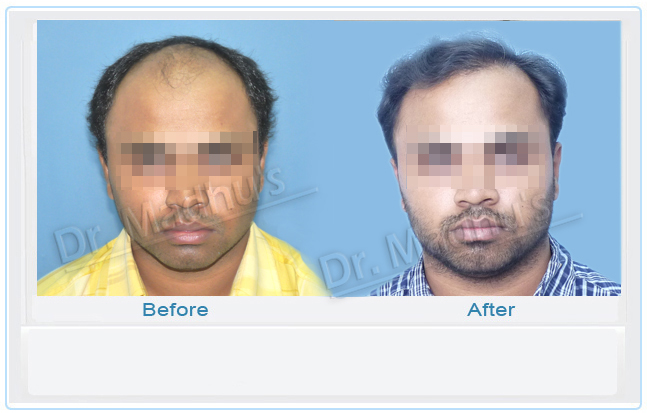 Hair restoration results Hyderabad