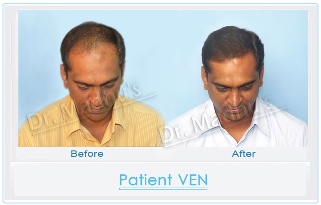 Hair transplant before after photos Hyderabad