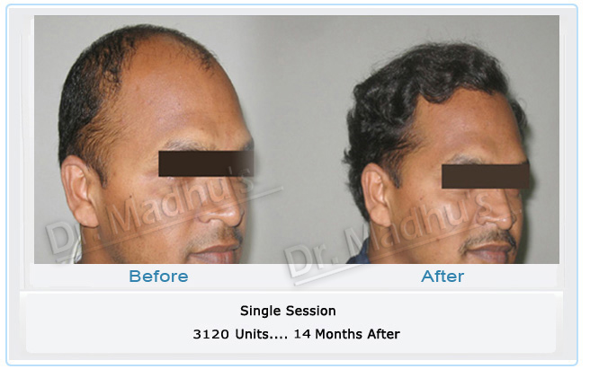 Hair transplant charges Hyderabad