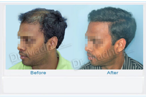 Hair transplant clinic near me Jubilee Hills