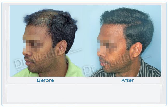 Hair transplant clinic near me Jubilee Hills