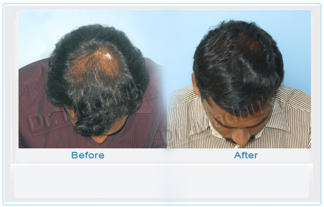 Hair transplant doctor Jubilee Hills