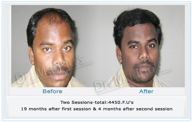Hair transplant for male patients Hyderabad