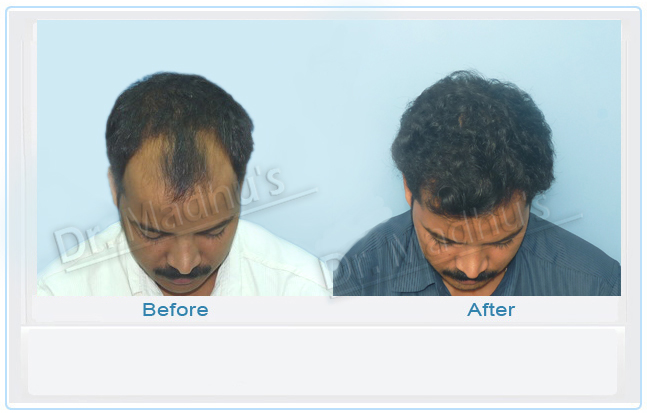 Hair transplant patient results Hyderabad