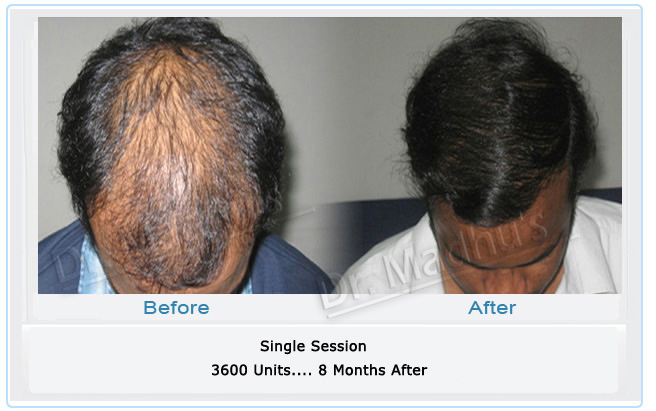 Hair transplant results Hyderabad