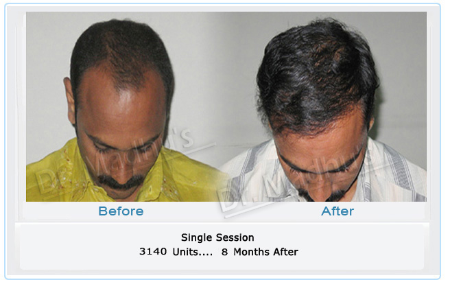 Hair transplant specialist Hyderabad