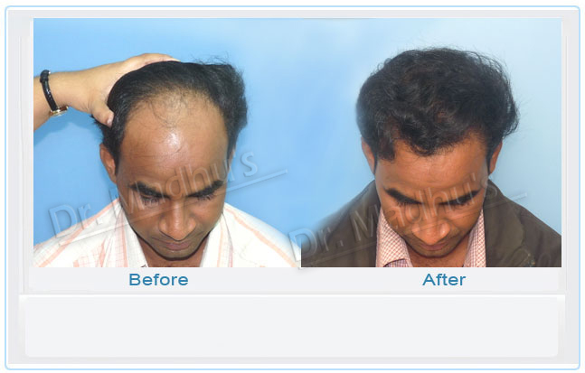 Hair transplant specialist Jubilee Hills