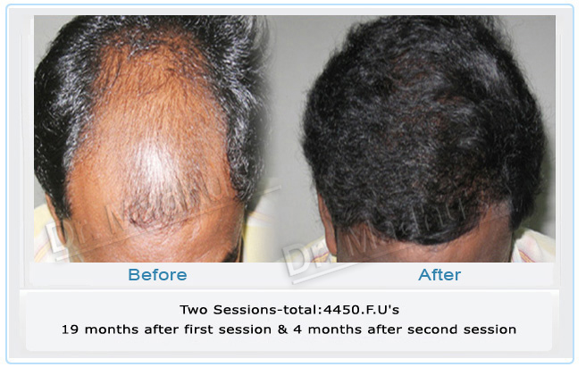 Hair transplant surgeon Hyderabad