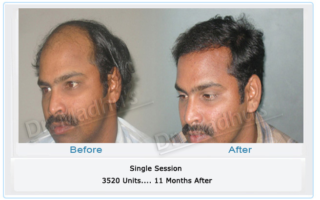 Male baldness solution Hyderabad