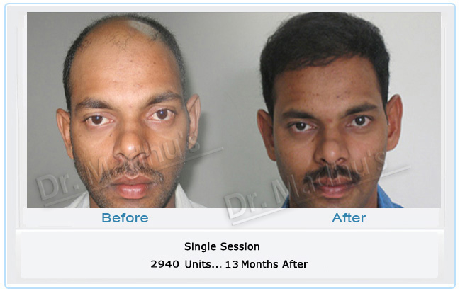 Male hair transplant Hyderabad