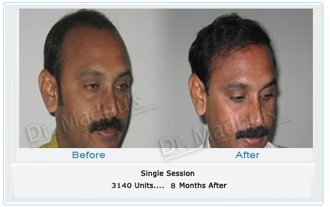 Men's hair restoration Hyderabad
