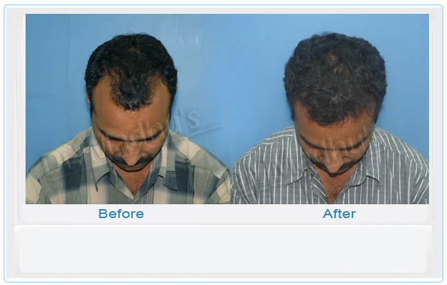 Natural looking hair transplant Hyderabad