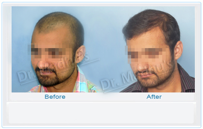 Successful hair transplant results Hyderabad