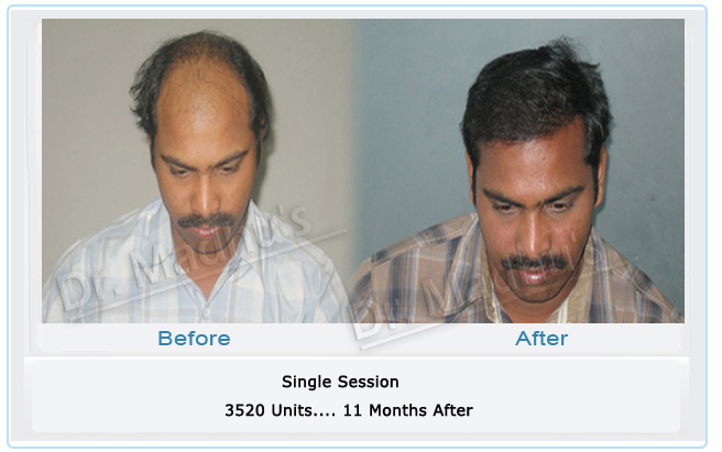 Top hair transplant doctor Hyderabad